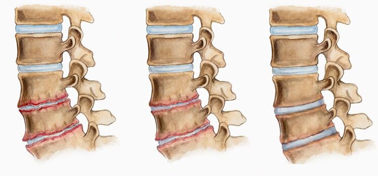 Osteokondrozda intervertebral disklerin deformasyonu sırt ağrısına neden olabilir