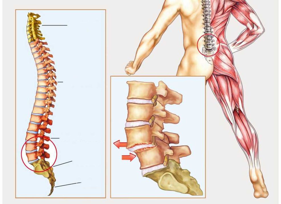 sağlıklı ve hasta omurga