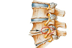 servikal osteokondrozun bir nedeni olarak omurganın sıkışmış diski